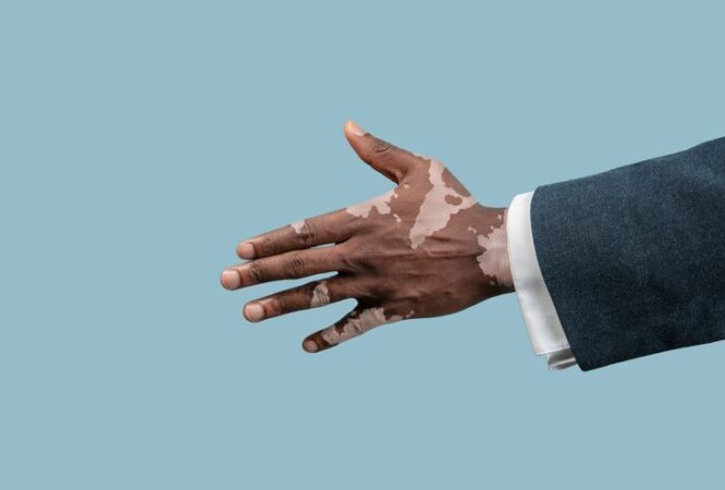 close-up-male-hands-with-vitiligo-pigments-isolated-blue-studio-background_155003-41795