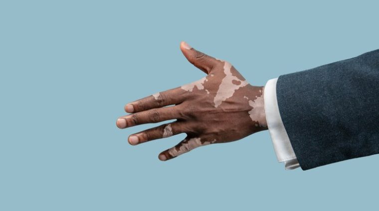 close-up-male-hands-with-vitiligo-pigments-isolated-blue-studio-background_155003-41795